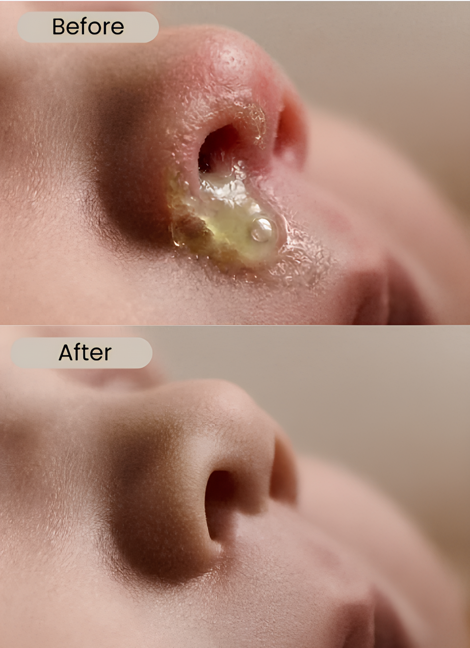 Puffyno™ Nasal Aspirator